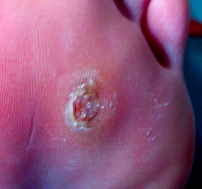 papiloma plantar, ojo de pescado