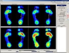 huella plantar por medico podologo